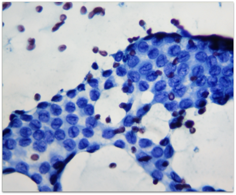 Citologia tireoide - Bethesda V