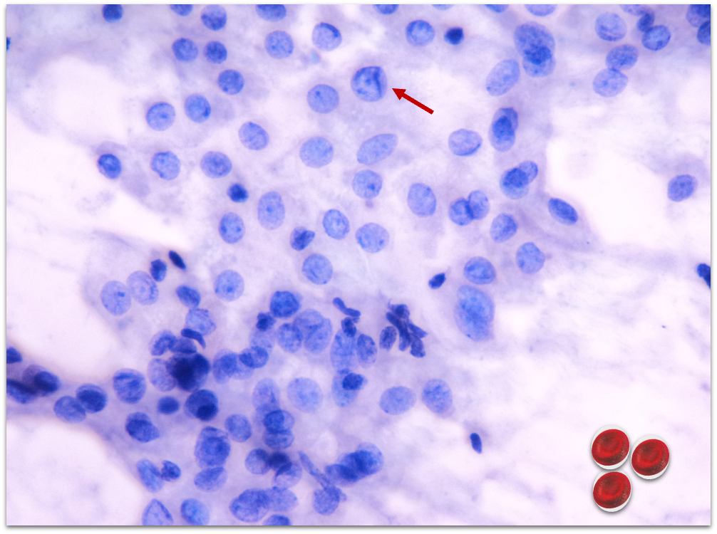 Atipia Nuclear - Tireoide